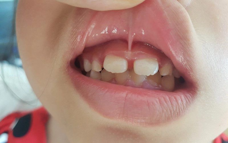 Chi phí cắt thắng lưỡi ở Quy Nhơn hiện nay là bao nhiêu?