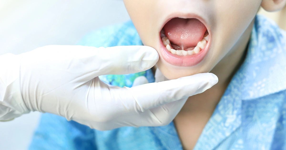 Đưa trẻ đi cắt thắng lưỡi